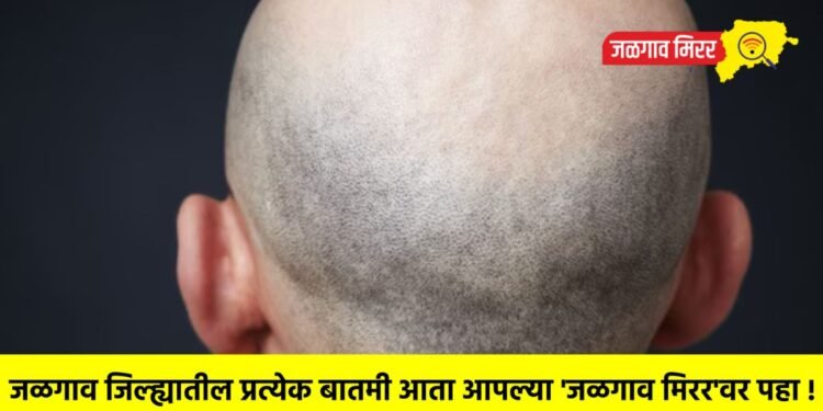 बापरे ! आता हे काय ?… या गावात ‘टक्कल व्हायरस’ची साथ ; तीनच दिवसात पडतेय टक्कल