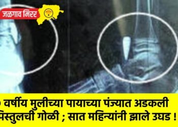 ९ वर्षीय मुलीच्या पायाच्या पंज्यात अडकली पिस्तुलची गोळी ; सात महिन्यांनी झाले उघड !