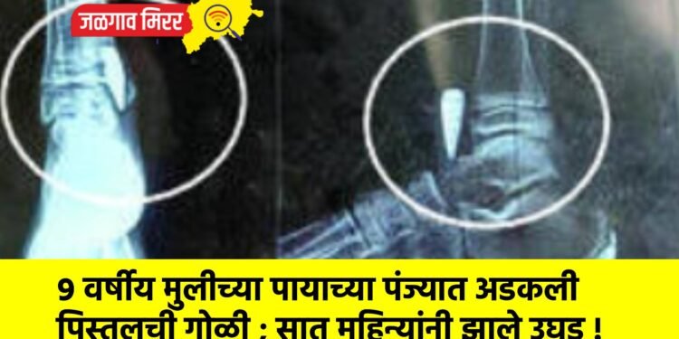 ९ वर्षीय मुलीच्या पायाच्या पंज्यात अडकली पिस्तुलची गोळी ; सात महिन्यांनी झाले उघड !